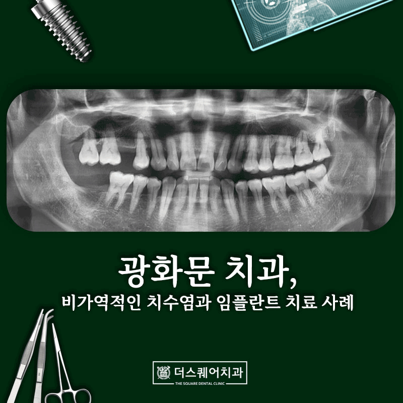 종로치과 비가역적인 치수염과 임플란트 치료사례