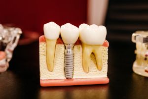 용인시-처인구-임플란트-치과-가격-비용-싼-곳,저렴한-곳,잘하는-곳,유명한-곳-BEST20-추천16