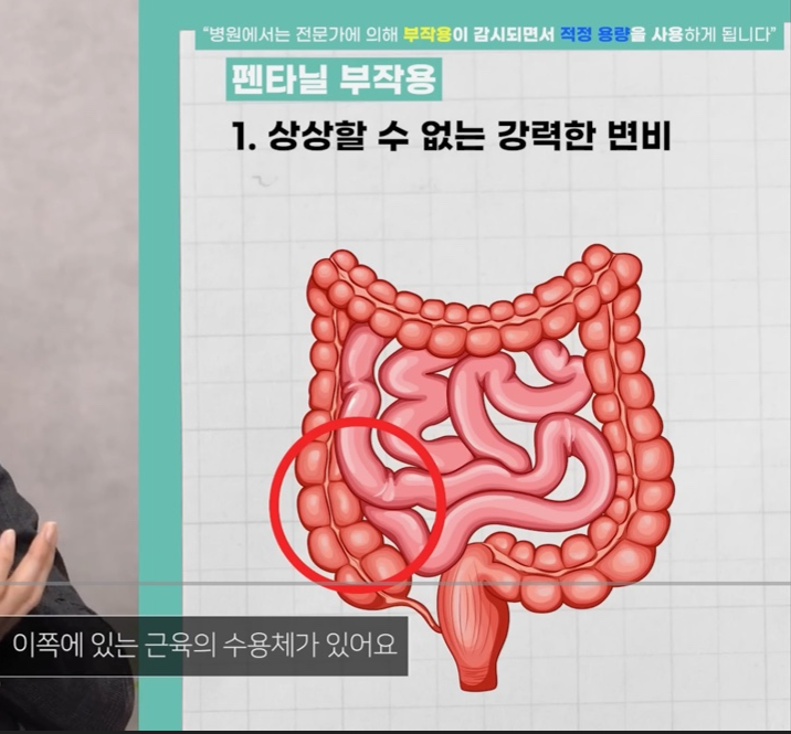 펜타닐 부작용으로 상상할 수 없는 변비 - 닥터프렌즈 출처