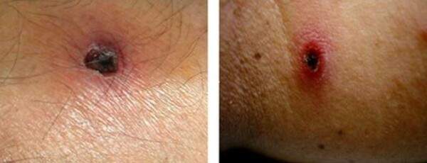 쯔쯔가무시의 초기 증상