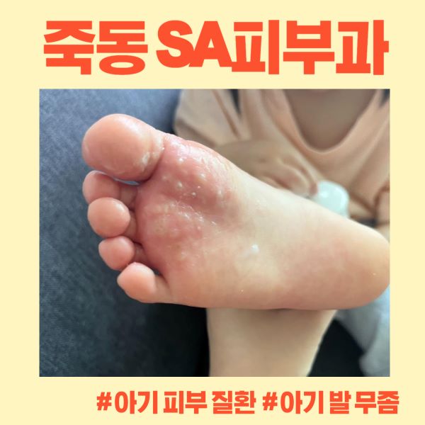 SA피부과 무좀 치료