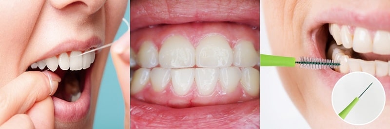 치은염과 치주염 예방법