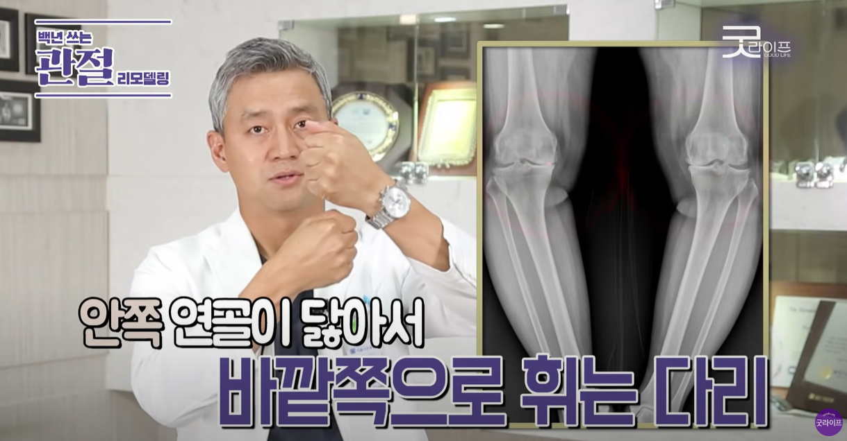 안쪽 연골이 닳으면 바깥쪽으로 휘는 다리가 됩니다