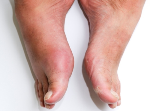 통풍_원인_예방 방법_좋은음식_나쁜음식