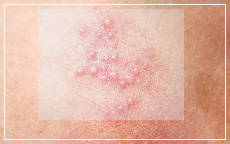 대상포진 수포형성