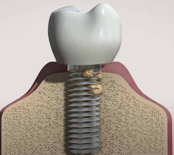 임플란트 주위염 ; 증상, 원인, 예방 및 관리방법 알아보기(재수술, 부작용, 재식립)