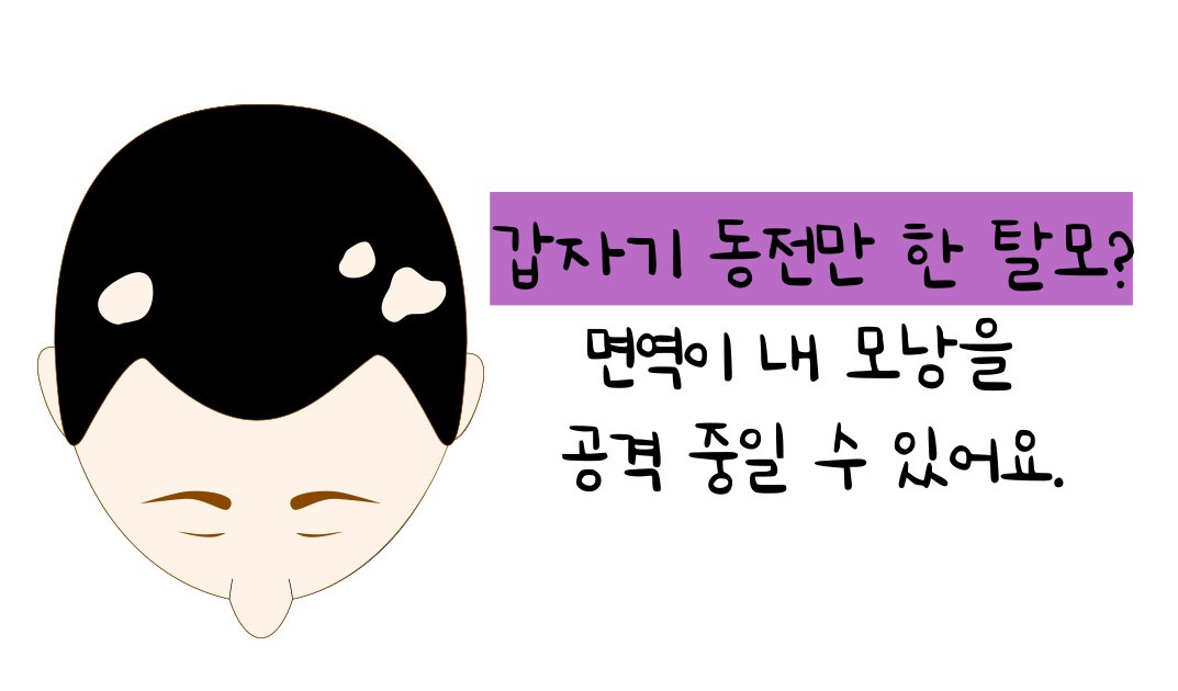 원형탈모 원인