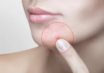 생리 전 뾰루지 폭발 원인과 해결법 7가지 생리 전후 뾰루지 발생 이유 완벽 분석_30