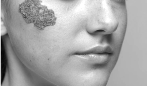 기저세포암(피부질환)