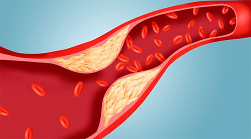 고지혈증에 나쁜 과일 6가지