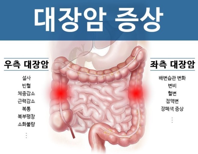 대장암 초기증상 이미지