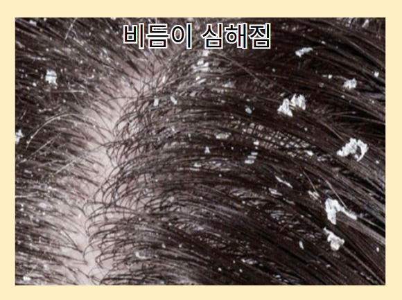 탈모 증상 - 비듬 심해짐