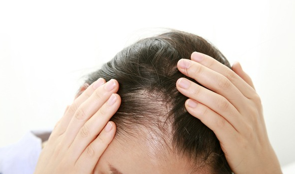 30대에 겪는 첫 탈모, 스트레스 때문만은 아니다