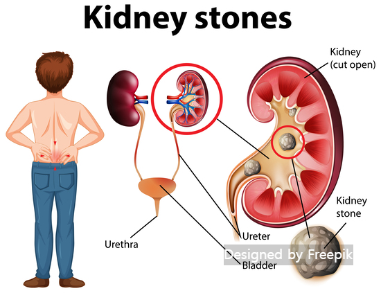 오른쪽 옆구리 통증 관련질환