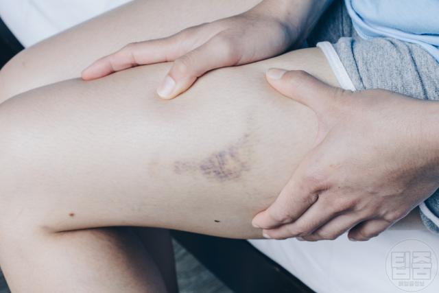 조기 폐경 전조증상 멍이 잘 생겨요