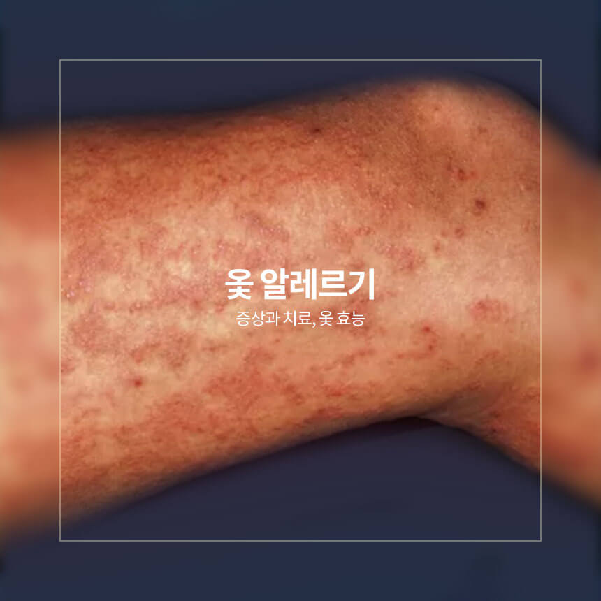 옻 알레르기 증상, 치료, 효능