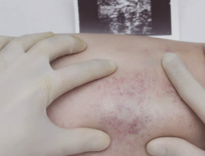 피부건조증 증상, 치료법, 좋은 음식과 연고 등 소개