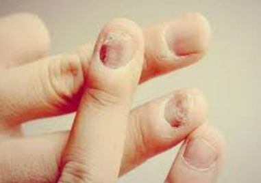 손톱 보호 : 외부 자극 최소화