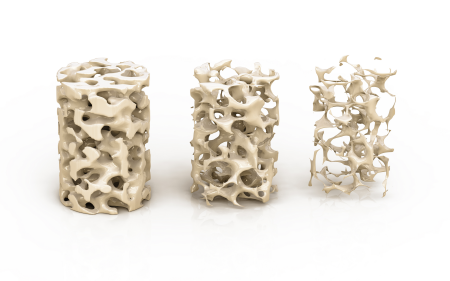 Osteoporosis 골다골증