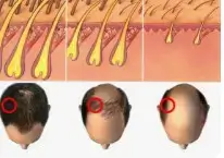 머리카락이 빠지고 정수리가 보이면 여성 탈모 진행별 증상과 해결책
