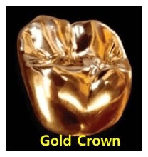 임플란트 보철재 비교 총정리 (Gold PFM Zirconia )