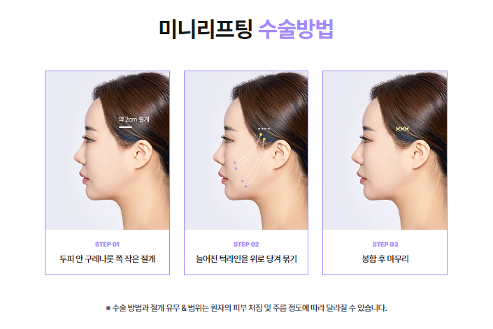 신사역안면거상 미니리프팅가격