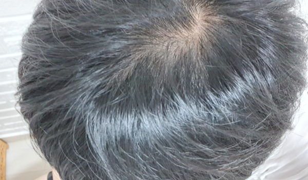 탈모가-진행중인-정수리