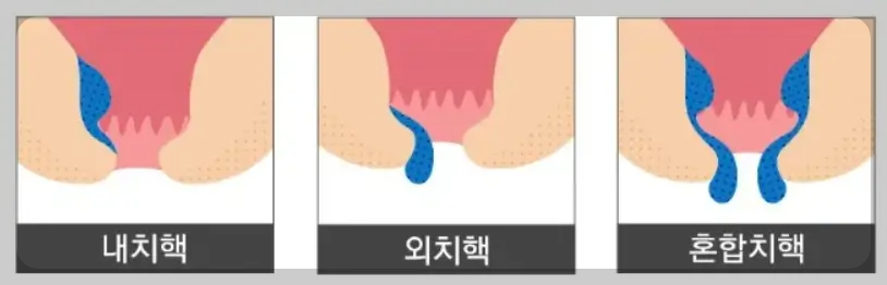 내치질 외치질 증상 차이