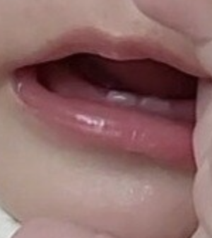 이앓이