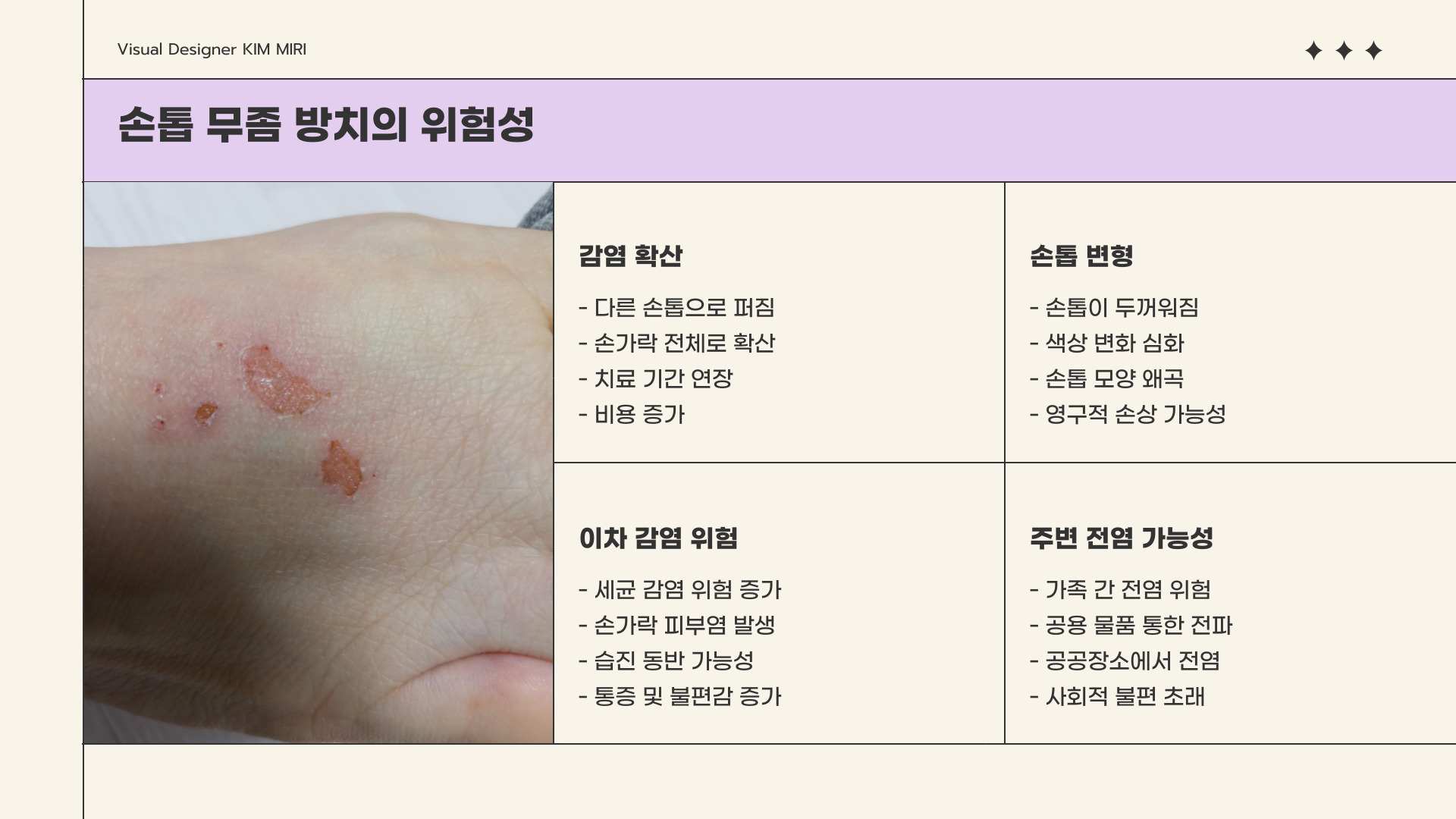 손톱 무좀