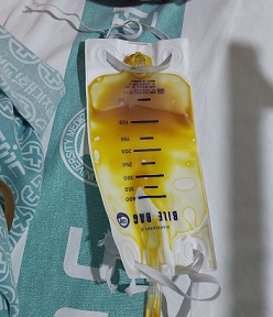 담낭배액술3일째담즙색깔