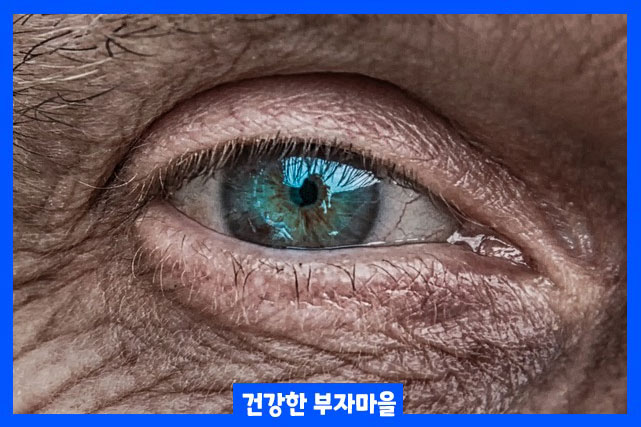 녹내장 초기증상 안압의 증가