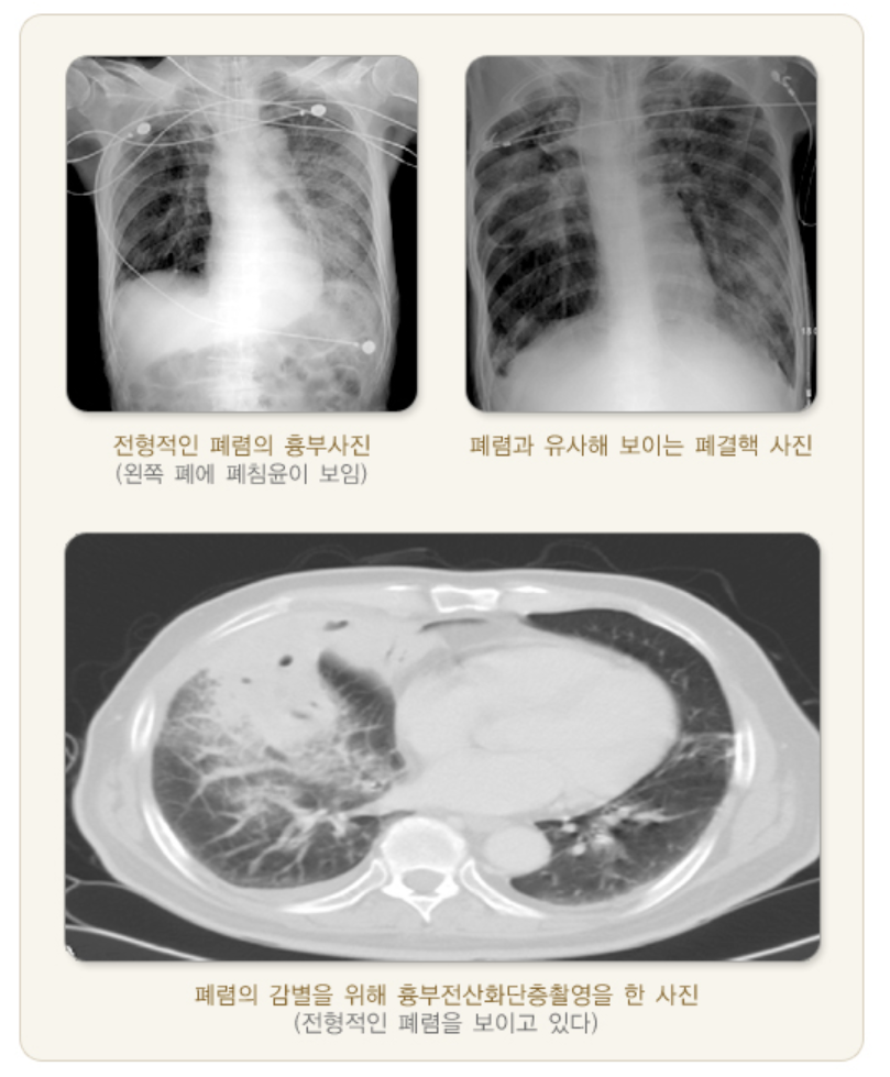 폐렴의 방사선 사진