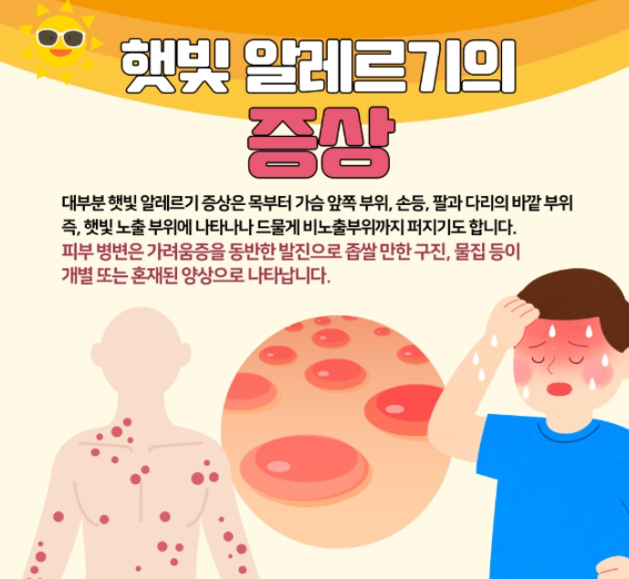 햇빛 알레르기 증상