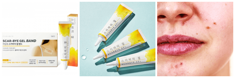 스카바이겔 밴드, 스카바이겔, 여드름 흉터 사진