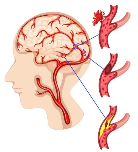 혈관 속 혈액 찌꺼기 양을 보여주는 모습