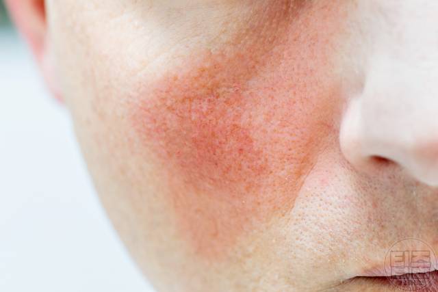 갑상선 기능 항진증 증상 갑상선기능항진증 자가진단 안면홍조 얼굴 붉어짐