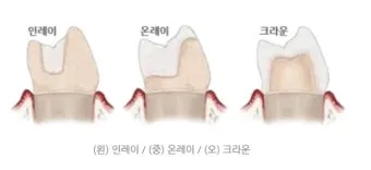 인레이 온레이의 차이와 치료 방법_3