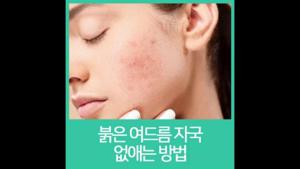 여드름 없애기