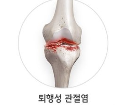 퇴행성관절염 증상 12가지 총정리 섬네일