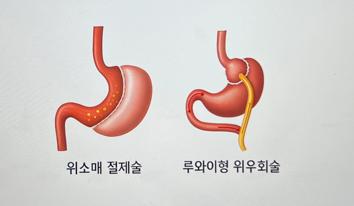 비만대사수술-종류-두-가지-예시-그림