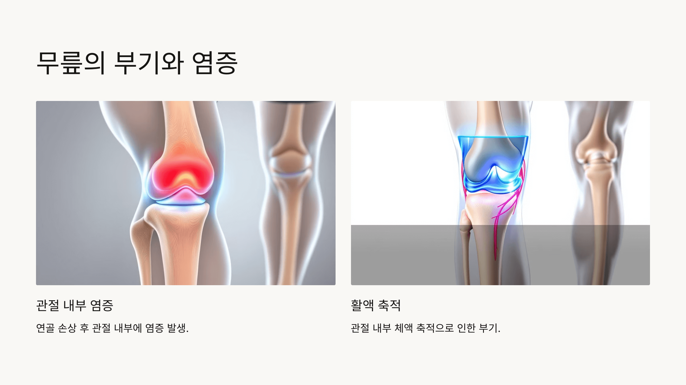 무릎 연골과 관련된 사진입니다.