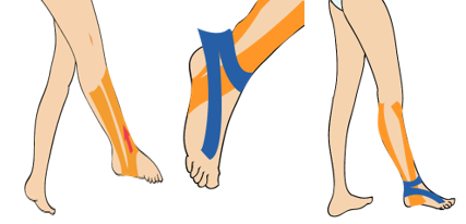 발목 외측 염좌(내반 염좌)