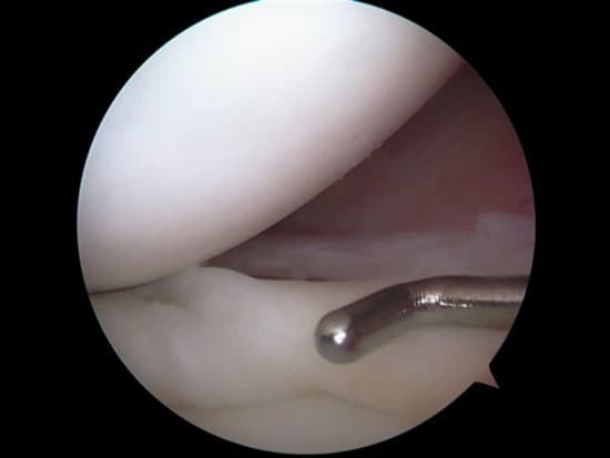 반월상 연골 파열 (Meniscus Tear)