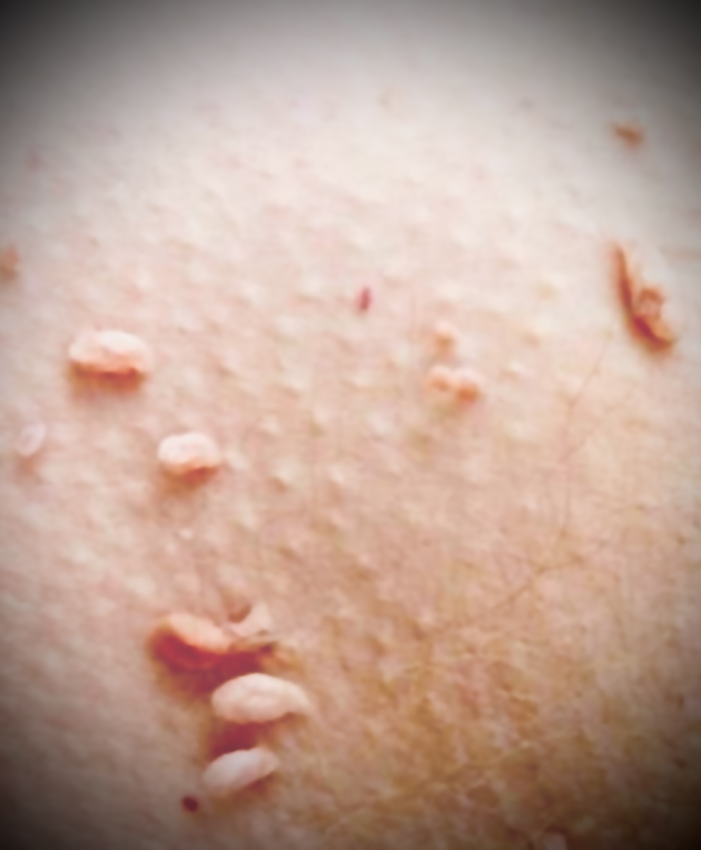 쥐젖 관련 사진