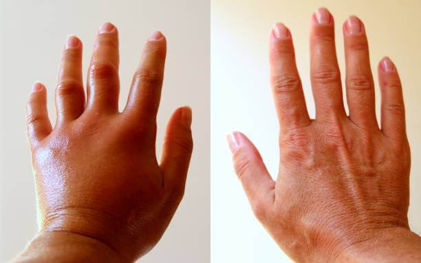 콩팥이 안 좋으면 나타나는 증상들이 있습니다. 콩팥은 간과 마찬가지로 침묵하는 장기이기 때문에 악화되어도 알아차리지 못하는 경우가 많기 때문에 주의가 필요합니다. 신장 건강에 문제가 생기면 여러 질병이 생길 수 있어 이러한 부분들을 잘 관리해야 합니다.