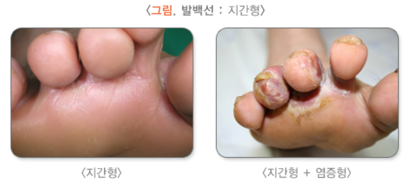 지간형 무좀