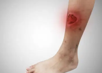 췌장암 초기증상 36