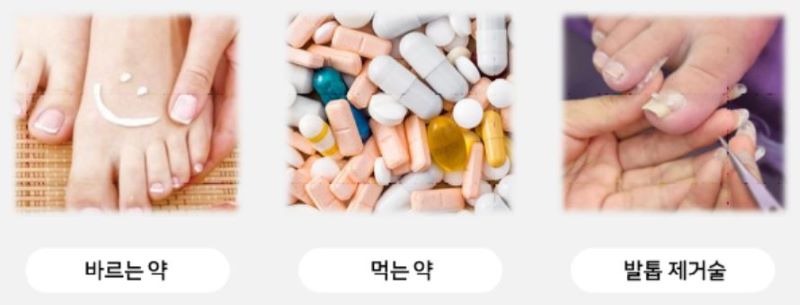 무좀 연고와 먹는 약 비교-효과, 부작용, 치료 기간 차이