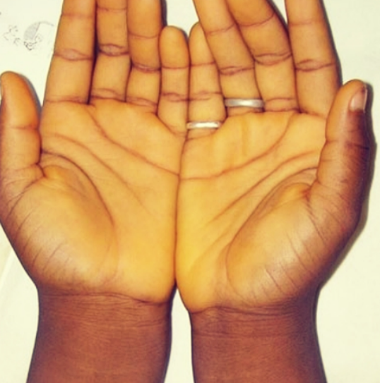 카로틴혈증이란